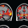 Brain Imaging Tests: A Comprehensive Overview