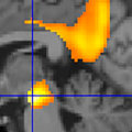 Clinical Diagnosis of Alzheimer's Disease: A Comprehensive Overview