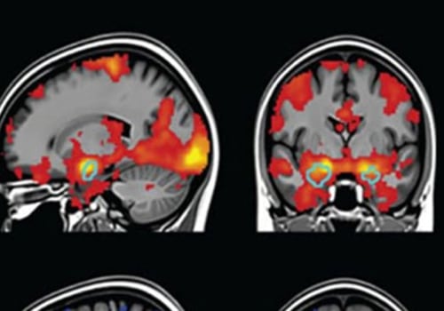 Brain Imaging Tests: A Comprehensive Overview