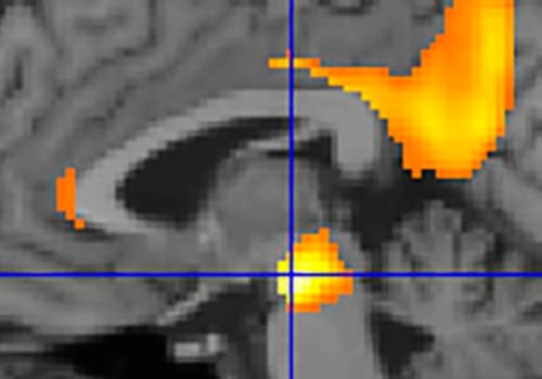 Clinical Diagnosis of Alzheimer's Disease: A Comprehensive Overview