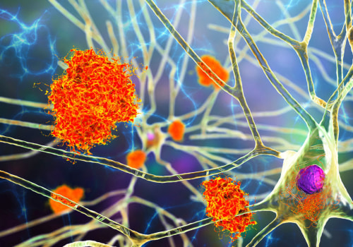 An Overview of Cholinesterase Inhibitors and their Role in Alzheimer's Treatment